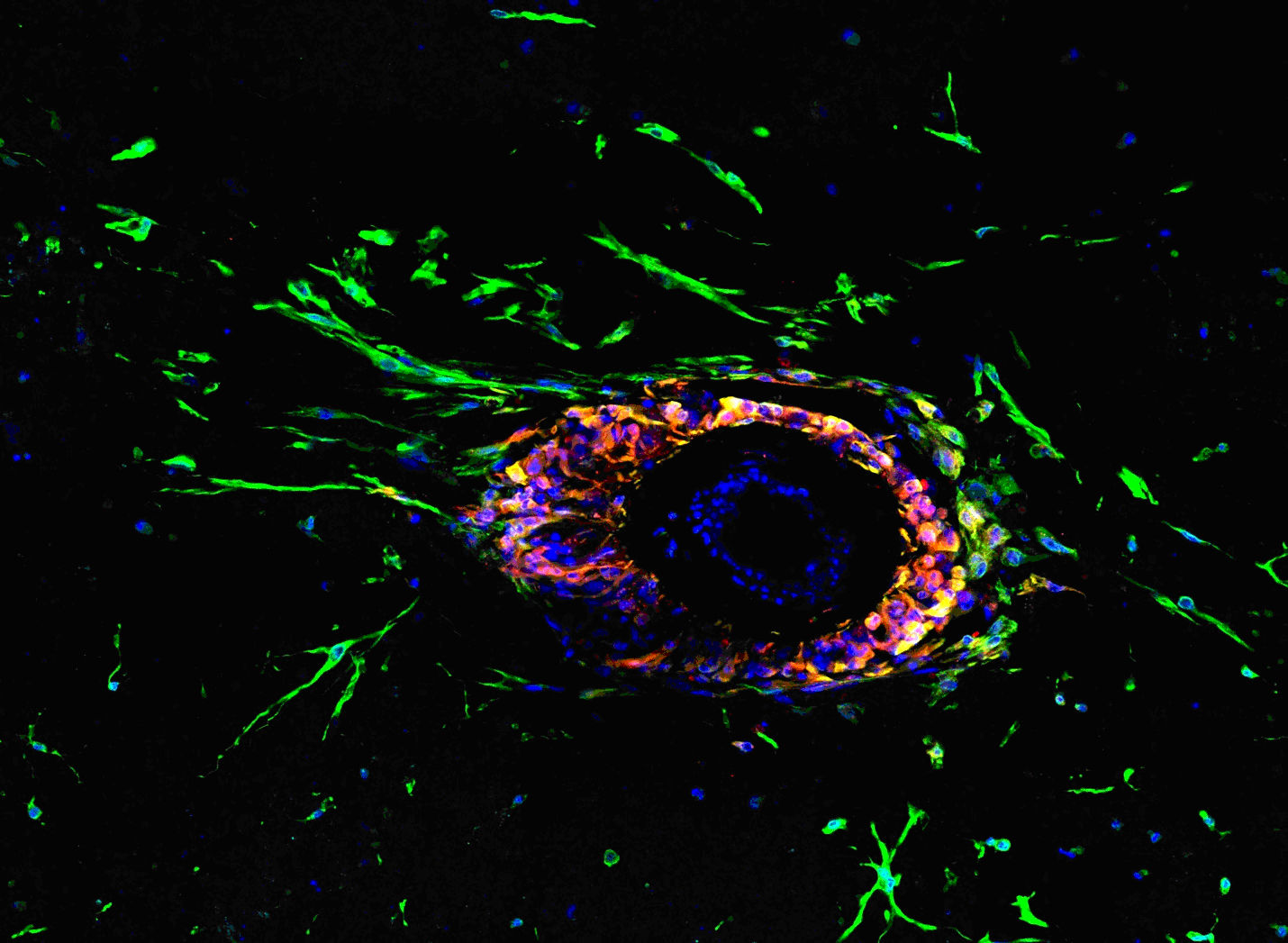 Tumor cells